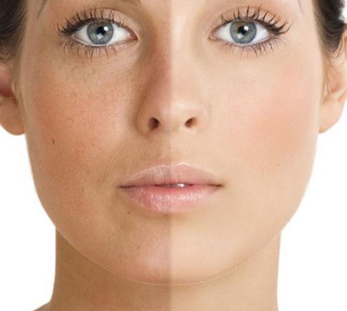Freckles Treatment