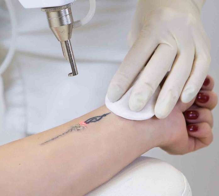 Laser Tattoo Removal