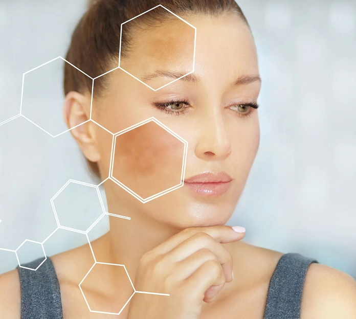 Melasma Treatment