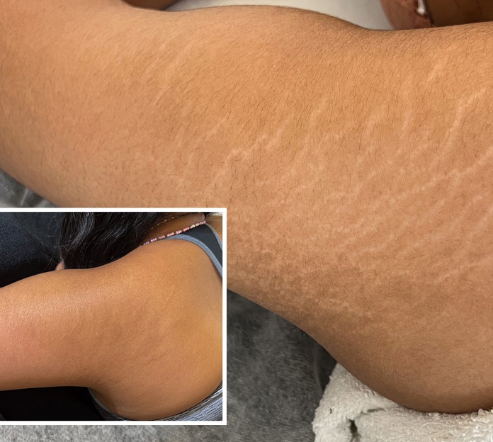 Stretch Marks Removal
